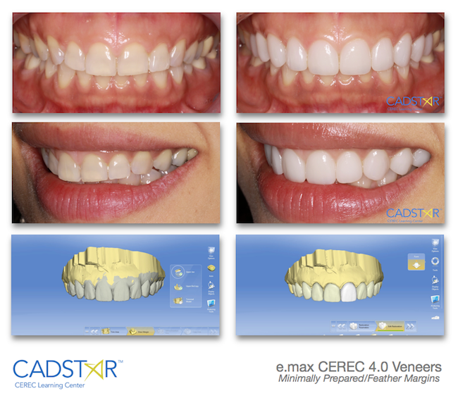 CEREC 4.0 Conservative Milled Restorations CADStar